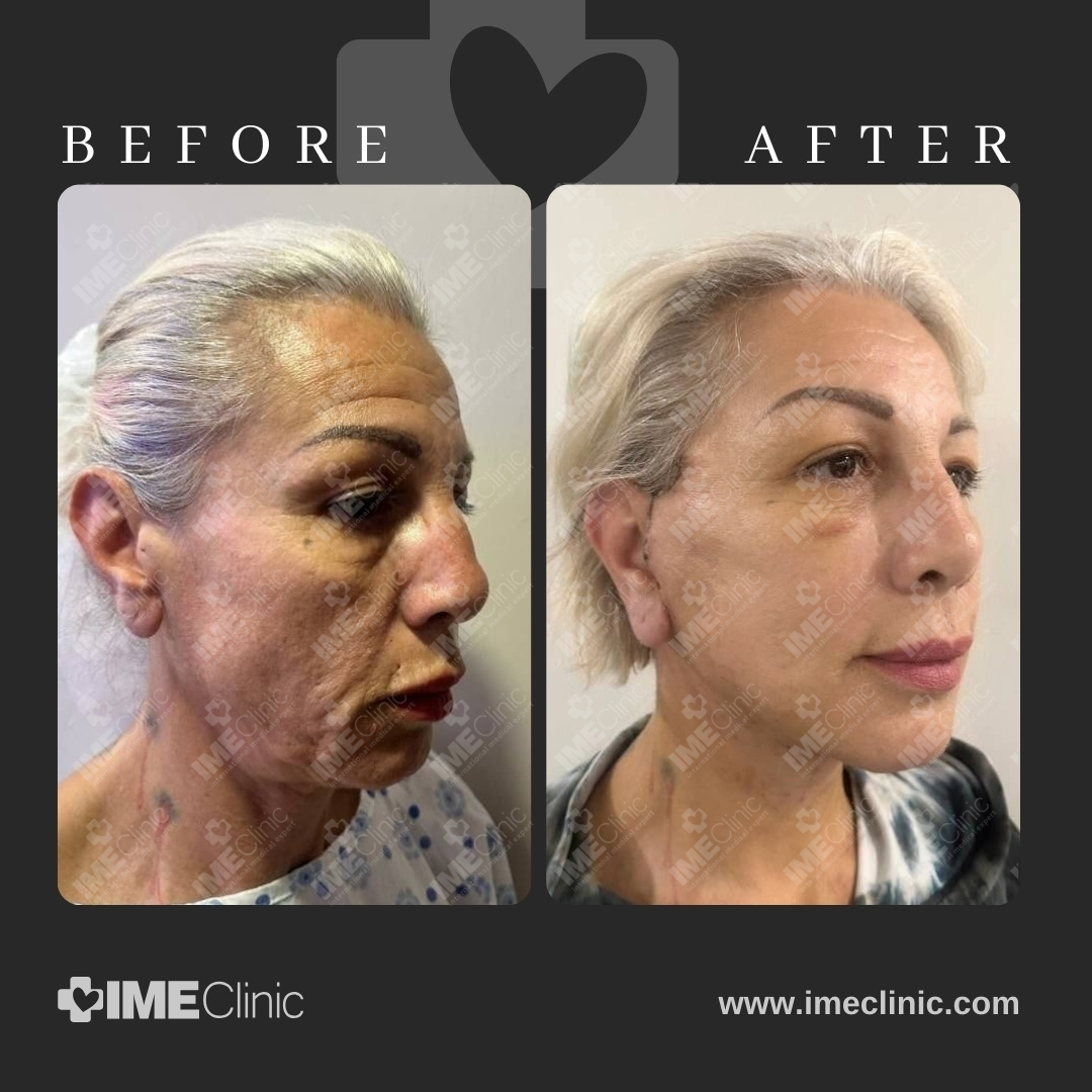 
                                     Side-by-side comparison of a persons face before and after a cosmetic procedure. The before image shows more pronounced skin aging, while the after image shows smoother, rejuvenated skin. Background features the IME Clinic logo and website.